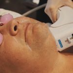 HIFU FACIAL 2