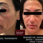 BORNE 15 BOTOX 2