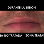 LABIAL HOMBRE