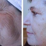 RADIOFRECUENCIA FACIAL