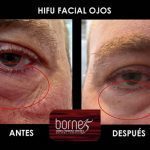 hifu-ojos-palma-mallorca-clinica-medicina-estetica-1