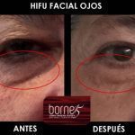 hifu-ojos-palma-mallorca-clinica-medicina-estetica-4