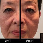 HIFU-Caso-Real-1-Borne15