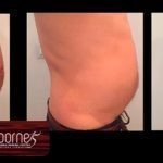 BORNE 15 Hifu-Caso-Real-5-Borne-15-N.P