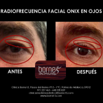 BORNE 15 RADIOFRECUENCIA ONIX FACIAL OJOS A.M.R