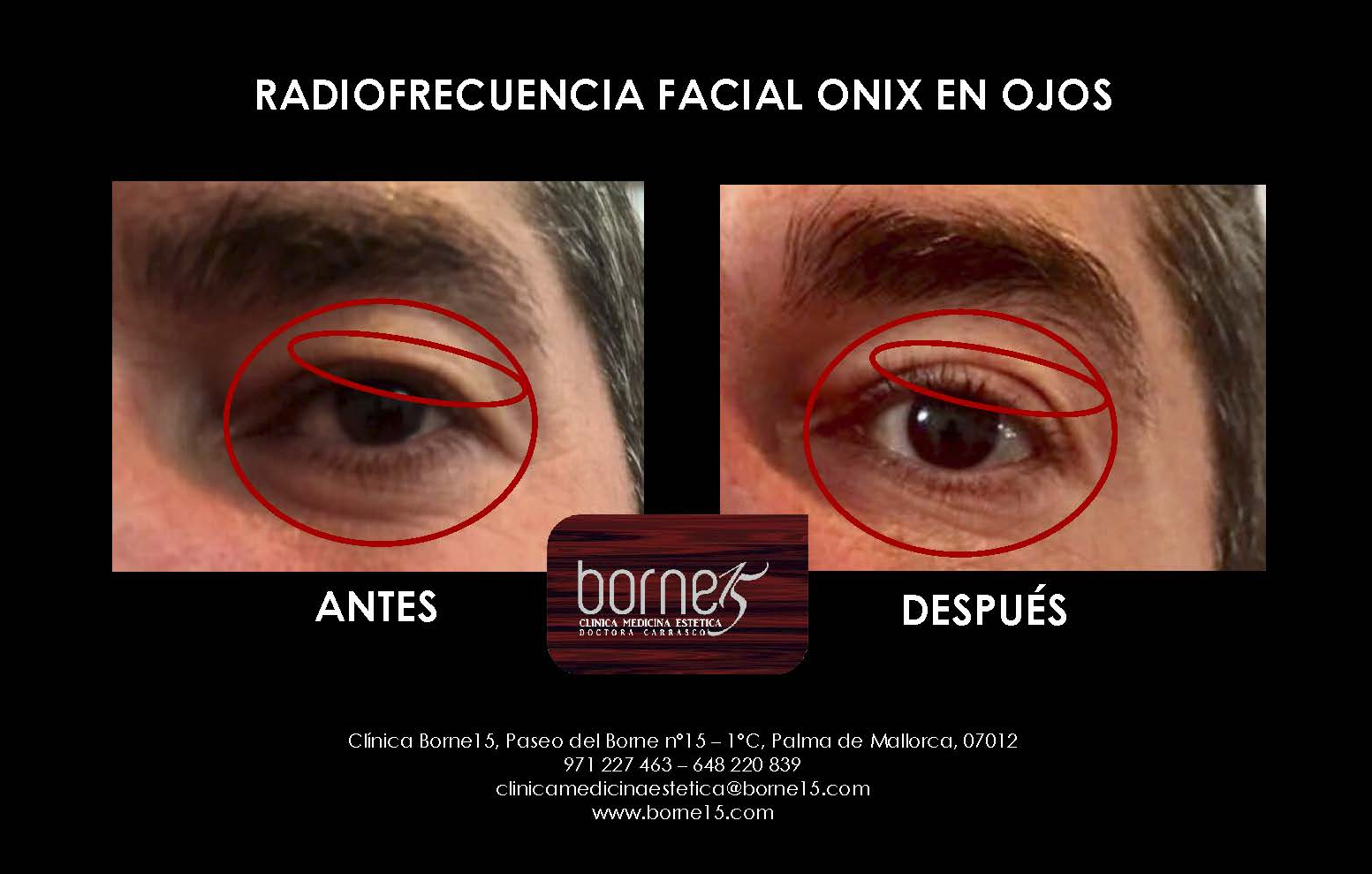 BORNE 15 RADIOFRECUENCIA ONIX FACIAL OJOS A.M.R - IB Magazine By Carlos ...