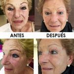 hifu-facial-palma-mallorca-clinica-medicina-estetica