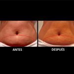 HIFU-ABDOMINAL-palma-mallorca-clinica-medicina-estetica-1