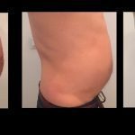 Hifu-Caso-Real-5-Borne-15-N.P.