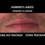 aumento-labios-clinica-medicina-estetica-palma-mallorca-1