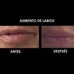 aumento-labios-clinica-medicina-estetica-palma-mallorca-3