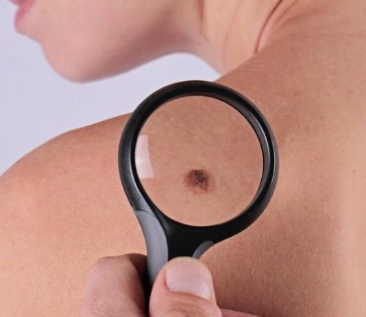 Tratar lesiones faciales antes del verano