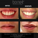 SONRISA GINGIVAL BORNE 15 2
