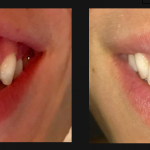 SONRISA GINGIVAL BORNE 15 2